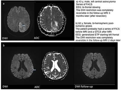 Frontiers | Acute DWI Reductions In Patients After Single Epileptic